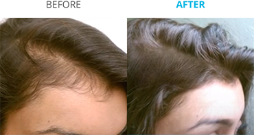 Theradome Before and After A
