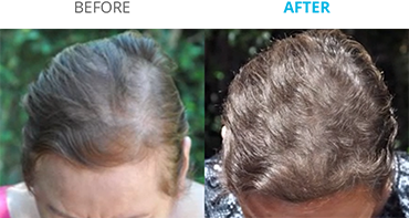 Theradome Before and After B