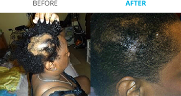 Theradome Before and After C