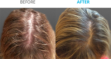 Theradome Before and After D