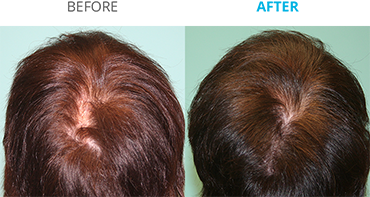 Theradome Before and After C