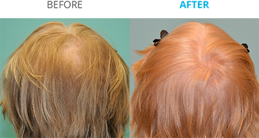 Theradome Before and After D