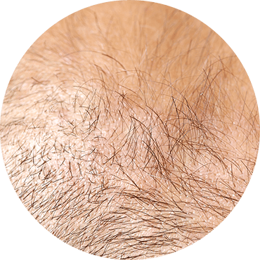 hair growth treatment - FDA approved